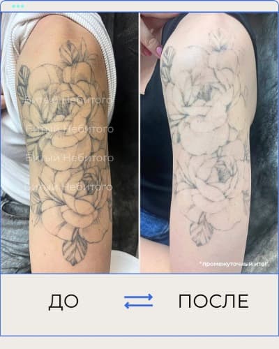 Удаление татуировки